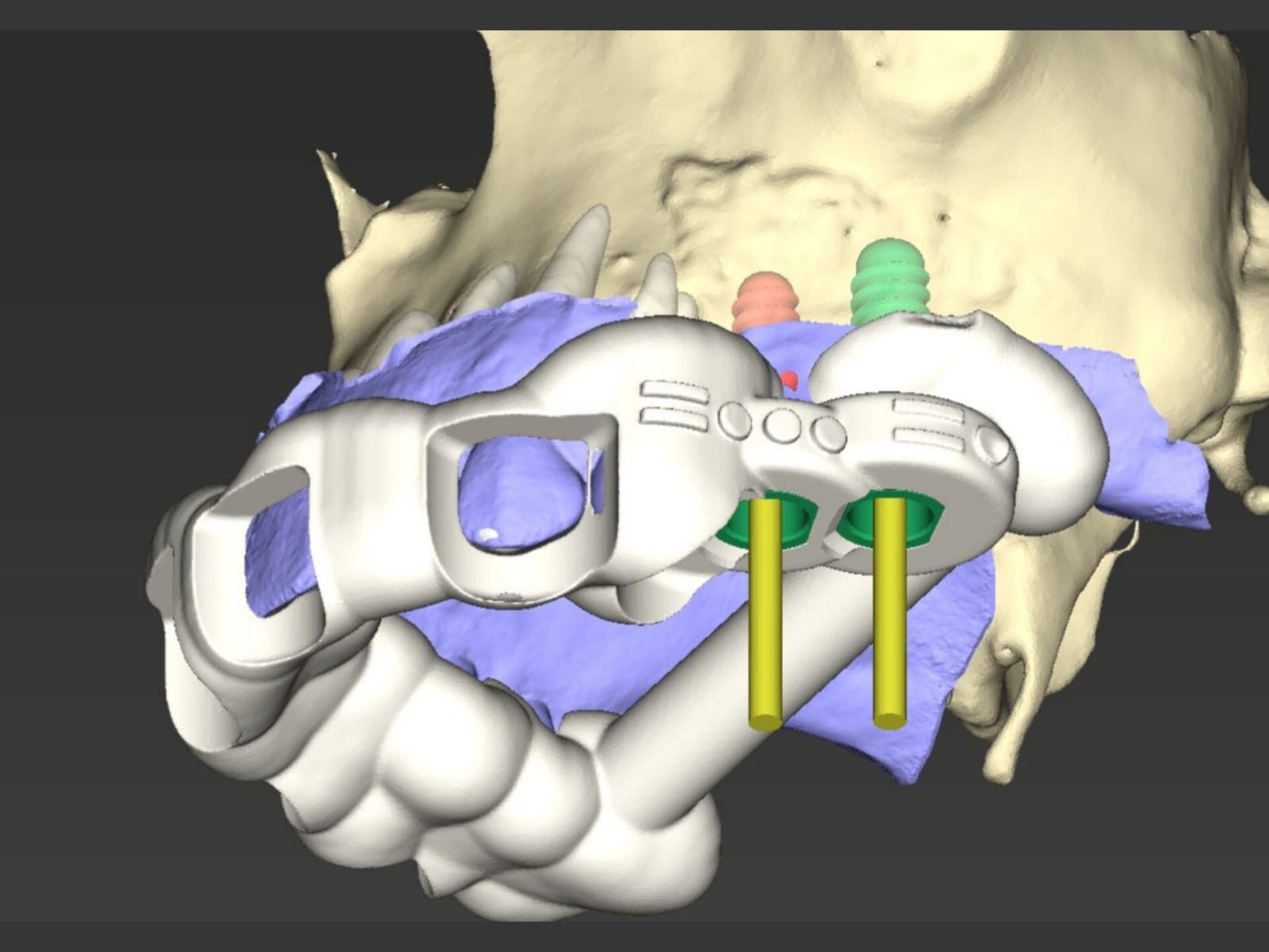 Guia para Implantes - Tomograf