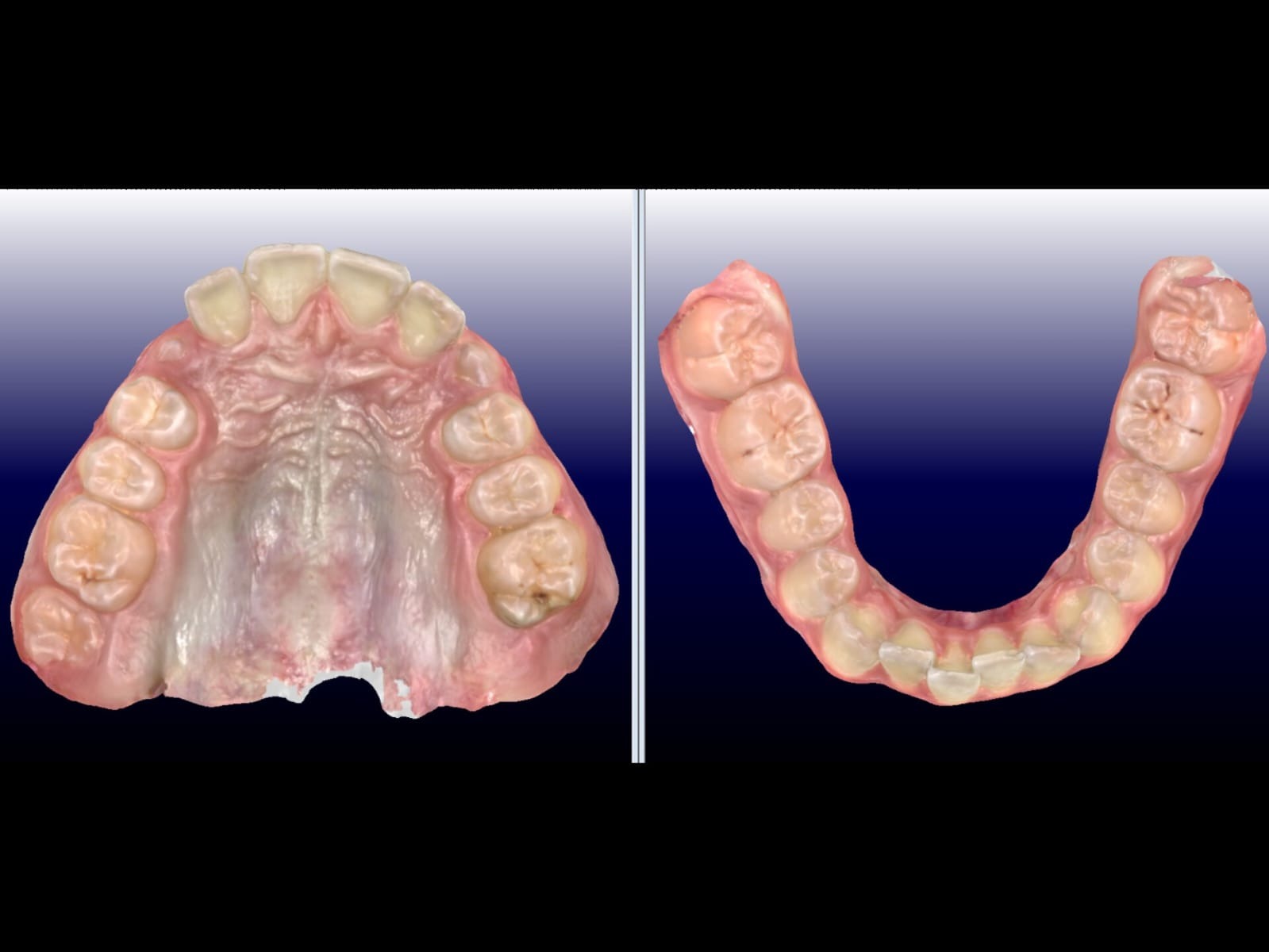 Escaneamento Intraoral