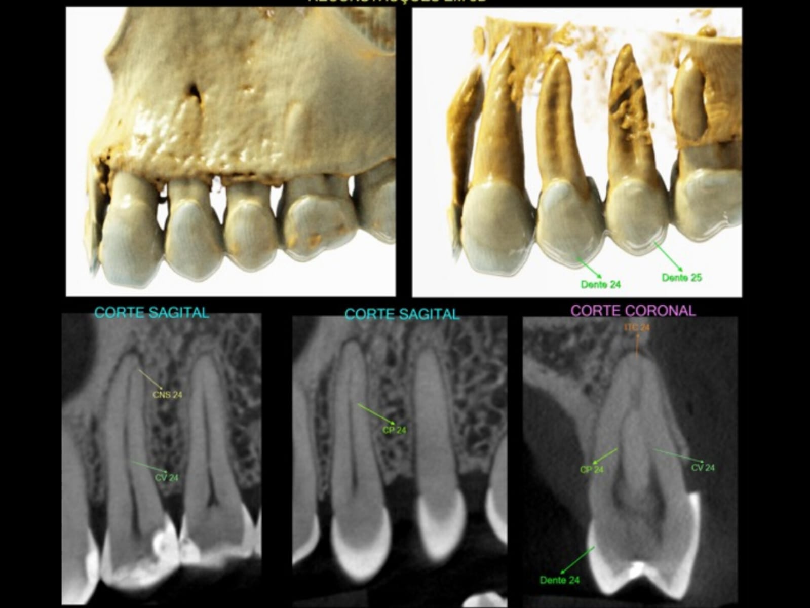 Guia para Implantes